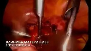 КРУТО! Очередная уникальная операция! Миомэктомия четырех узлов с комментариями