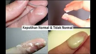 Tanda - Tanda Penyakit Keluar Lendir Sperma Dari Kemaluan Pria Maupun Wanita