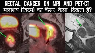 मलाशयका कैंसर Rectal cancer #petctreportkaisedekhe #petctreportreading #petct #petctscan #mri