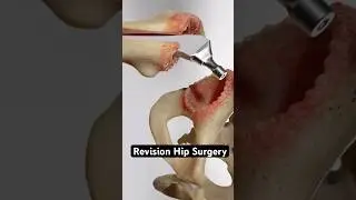 Revision Hip Surgery (3D Animation)