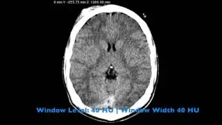 CT Scan of the Head: A Radiologist's Approach