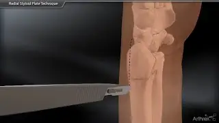 Radial Styloid Plate Technique