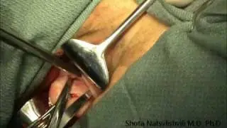 Vaginal Hysterectomy. Uterine Fibroids