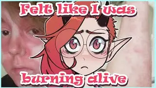 I Almost Went Septic (AGAIN!) STORYTIME
