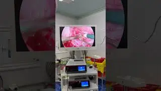 Дренирование Эхинококкоза.