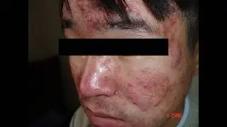 Acne vulgaris and Rosacea