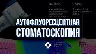 Аутофлуоресцентная стоматоскопия