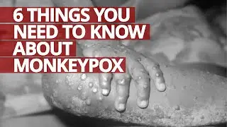6 Things You Need to Know About MONKEYPOX