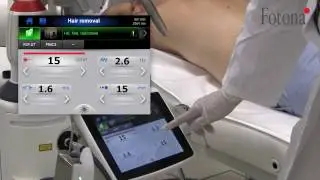 Láseres Fotona - Depilación con Frac3, R34-T y MatrixView (Nd:YAG)