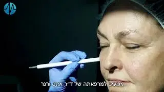 הרמת עפעפיים ללא ניתוח דר אינס ורנר