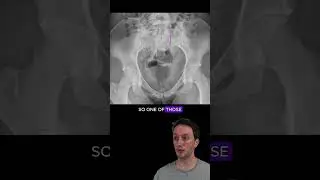 Sacral ala fracture with disruption of the arcuate lines 