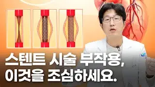 심장질환 중 협심증 치료, 막힌 혈관을 뚫어주는 스텐트 시술의 부작용을 미리 알고 치료받자!!