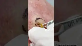 DEEP Dilated Pore of Winer | Dr. Pimple Popper 