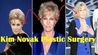 Kim Novak Plastic Surgery Gone Wrong | Before and After