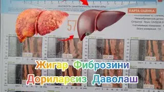 Жигар фиброзини дориларсиз даволаш