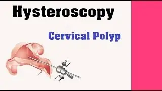 Hysteroscopy - Cervical Polyp