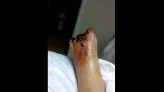 amputation that fixed my dead toe problem