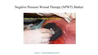Negative Pressure Wound Therapy NPWT Market to Rea