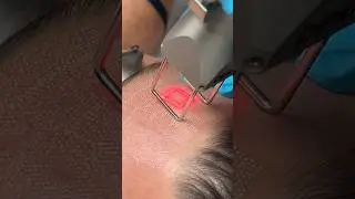 Co2 Resurfacing with #co2 #laser #resurfacing #trending #shorts #reels #viral