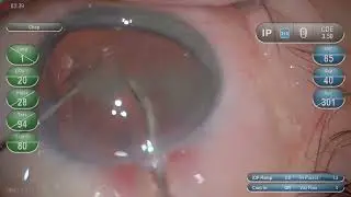 Horizontal chop + epinucleus  flip