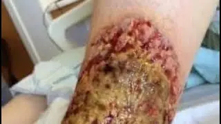 Clinical Case presentation: enlarging necrolytic lesion in the leg