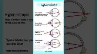 Defects in Human Eye: Myopia & Hypermetropia | Study Guide & Tips | Fun Science Learning