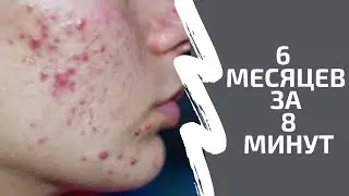 Лечение акне 6 месяцев за 8 минут. Акнекутан Роакутан