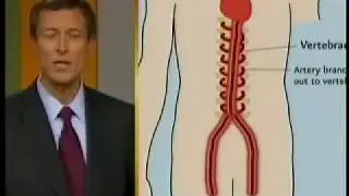 Kickstart Your Health, Dr Neal Barnard Part 2: arteries blockage,  cholesterol, diabetes