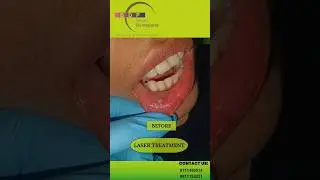 MUCOCELE Removal with Dental Laser: Dr. Srishti Bhatia #laser #mucocele #painlessdentistry