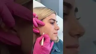 masseter botox #plasticsurgery #jawline #shorts #botox