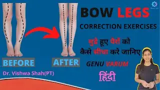 Bow Legs Correction Exercises | Bow knees workout | Knee pain relief treatment| Genu Varum Arthritis