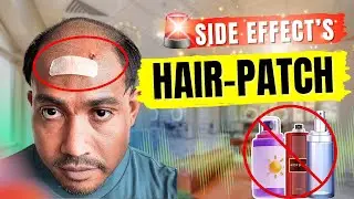 🔥❌ Side effects of Hair Patch Product & Wigs | Side Effects of Hair Patch Glue हेयर पैच के नुकसान