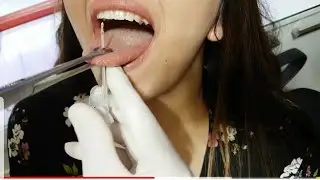Dil - Tongue - Piercing Deldirme !! Kısa Sürede İyileşmesi İçin Gerekenler ??