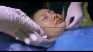 Pdo Double Needle Threads Double Chin Treatment Tutorial