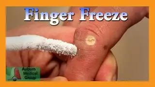 Finger Wart Cryotherapy Probe | Auburn Medical Group