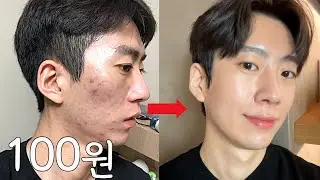 광고❌ 100원으로 여드름+지루성두피염 한방에 해결하는 방법❗(+Q&A)