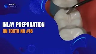 Inlay Preparation on Tooth No #18 |  Caapid Simplified Bench Prep Course