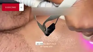 Continuation of Butt Laser Hair Removal