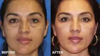 Facial Plastic Surgeon Explains How to Take 10 Years off your Eyes With Surgery (blepharoplasty)