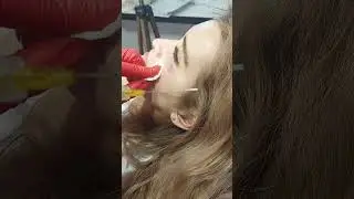 15.11.23  ГК орбита .Канюля. Работа над над подглазничной связкой.