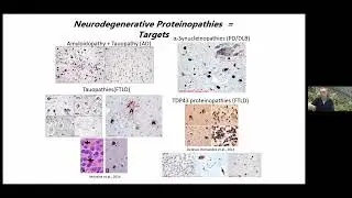 The Dementia Tsunami and Introduction to Biomarkers
