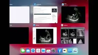 cardiac US RV strain podcast