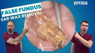 FALSE FUNDUS EAR WAX REMOVAL - EP1106
