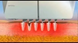 Invasix Fractora
