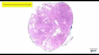 Nerve: Schwannoma Microscopy (Talking slide)