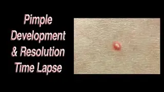 Pimple Development & Resolution Time Lapse