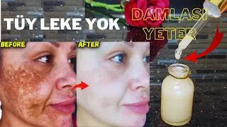 %100 Etkili! Patates ve Aloe vera jelini karıştırın, Yüzdeki pigment lekelerini silin!Patates Serumu