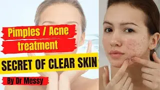 How to remove pimples/acne. Secrets of healthy skin #skincareroutine #pimples #acne