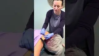 Dry Needling is magic for tight muscles. #dryneedling #headache