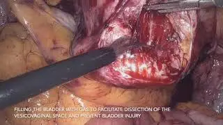 Laparoscopic sacrocolpopexy experience with HAlbaMesh by Dr.Stephen Jeffery